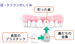 冠・クラウンのしくみ
